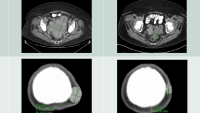 Representative images from a subset of patients achieving partial response on the study; showing shrinkage in mass size of tumors